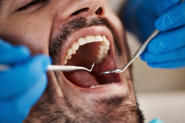 Best Wisdom Tooth Removal  in Mountlake Terrace, WA